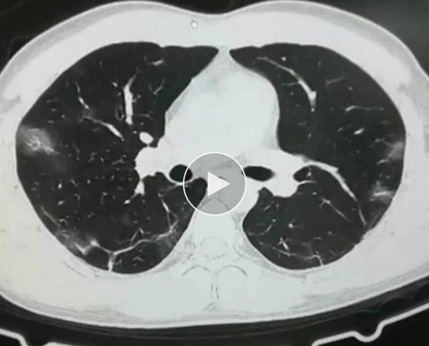 新冠患者肺部图片
